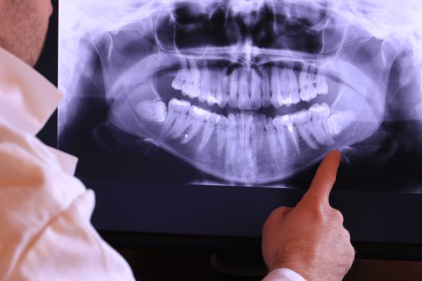 Best Emergency Wisdom Teeth Removal in Columbus, OH